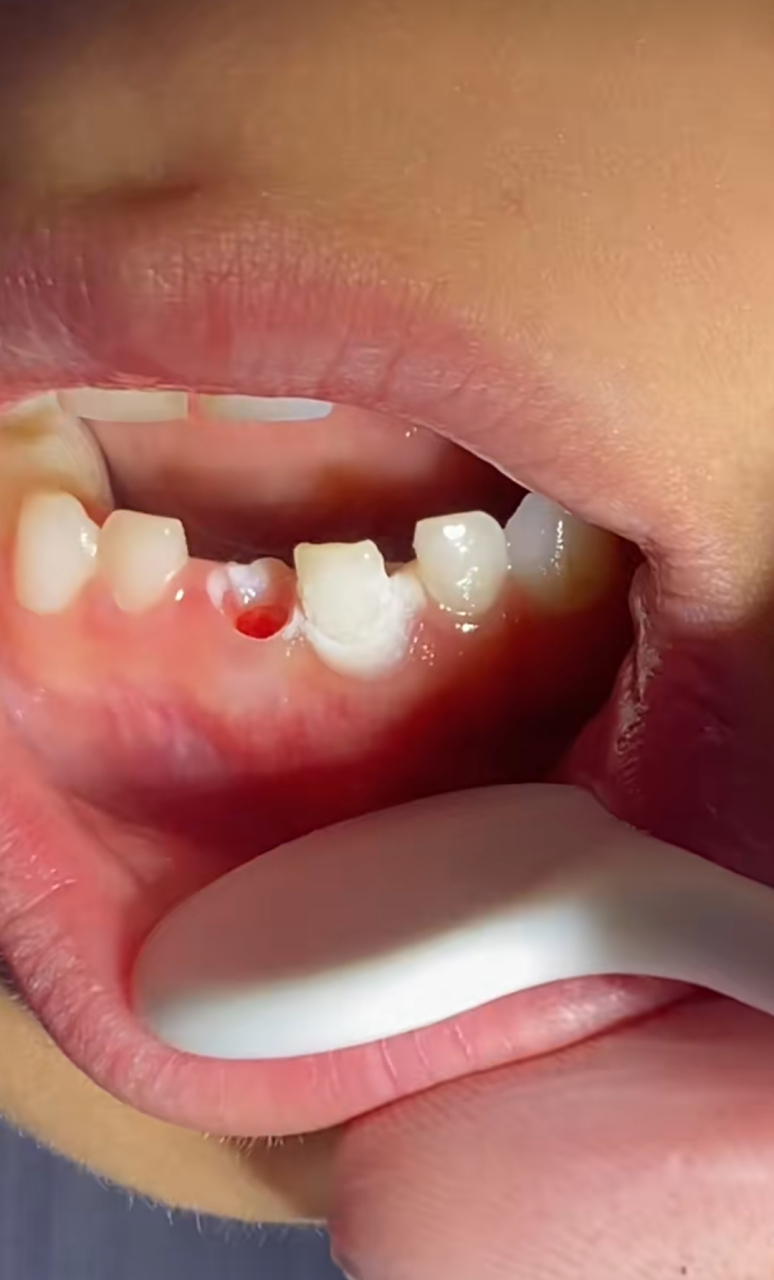 现在的人啊,乳牙会自己掉,你非得人工给拔掉,不知道怎么想的[汗]