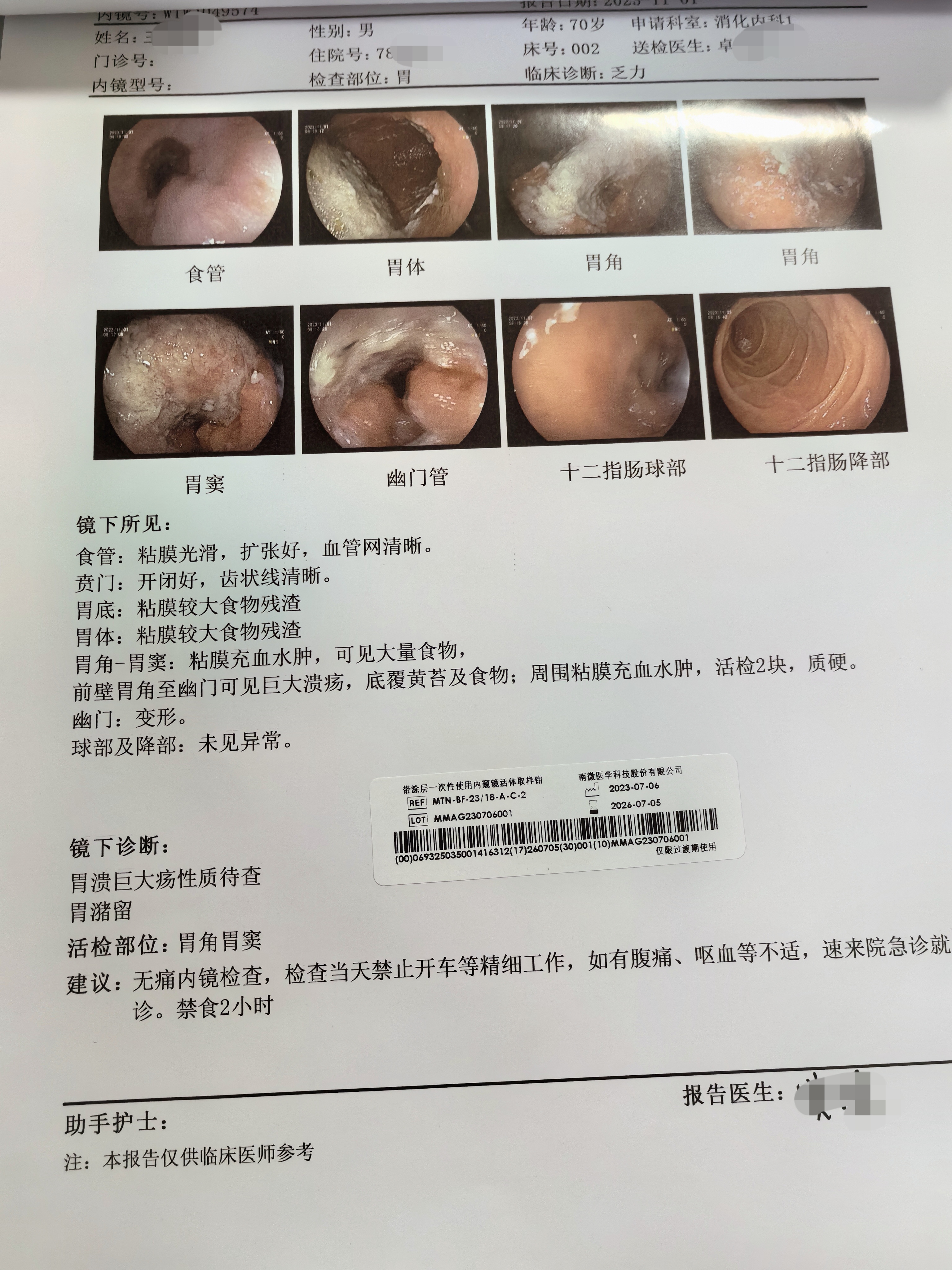 胃角巨大溃疡图片