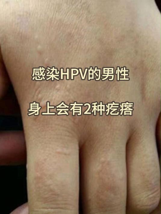 感染hpv的男性,身上会有2种疙瘩