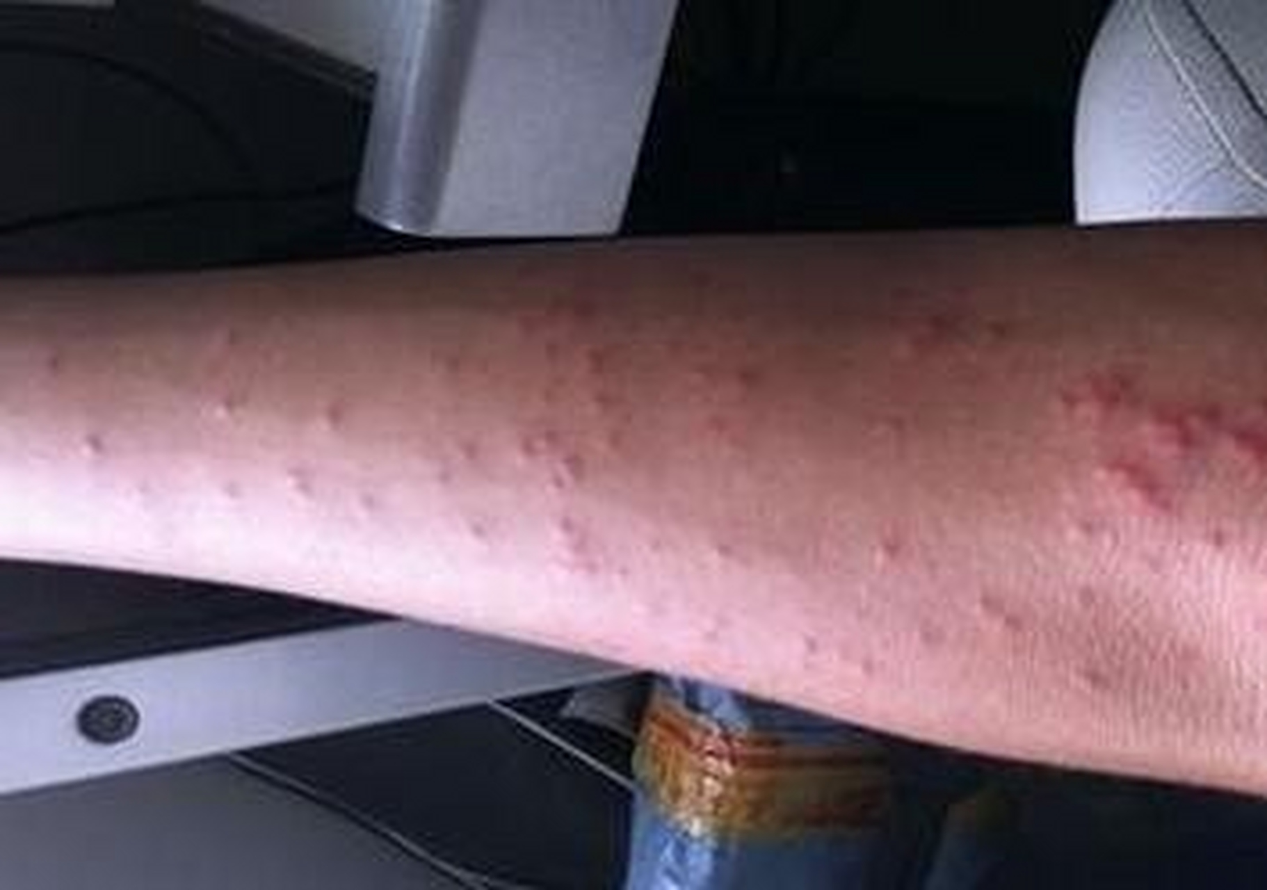 如何区分荨麻疹和湿疹 那么有很多人啊,可能是得了一些皮肤过敏性疾病