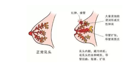 浆细胞性乳腺炎照片图片