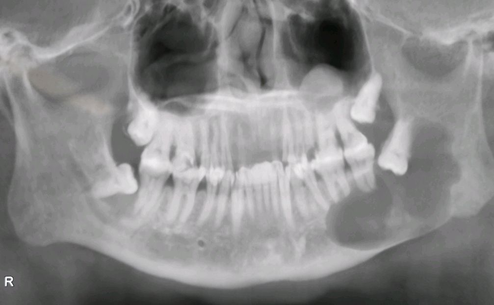 含牙囊肿影像学图片