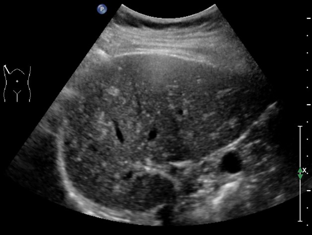 医学超声中的"满天繁星",其实是肝内胆管错构瘤