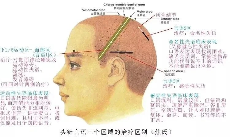 头皮针言语一区位置图图片