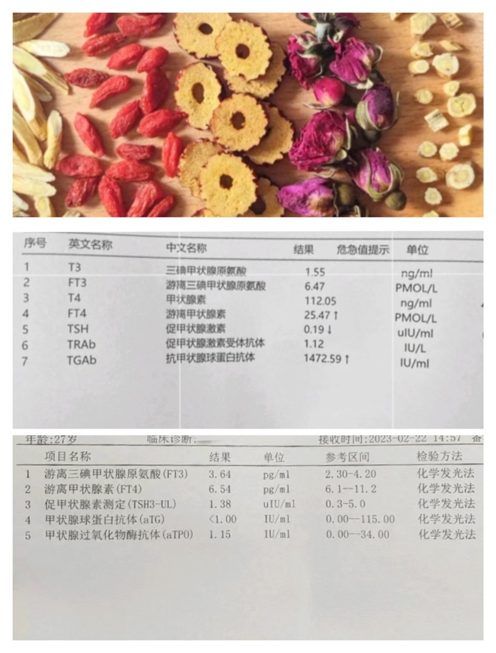 抗体1500→1?#桥本氏甲状腺炎