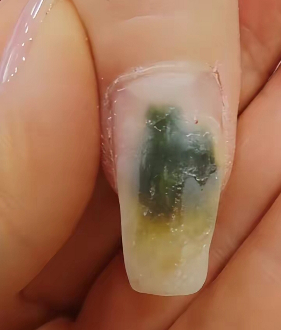 女子贴甲片后指甲发霉变绿,店老板:10个指头绿了6个,大拇指指甲和肉