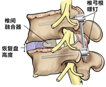 椎管狭窄图片解析图片