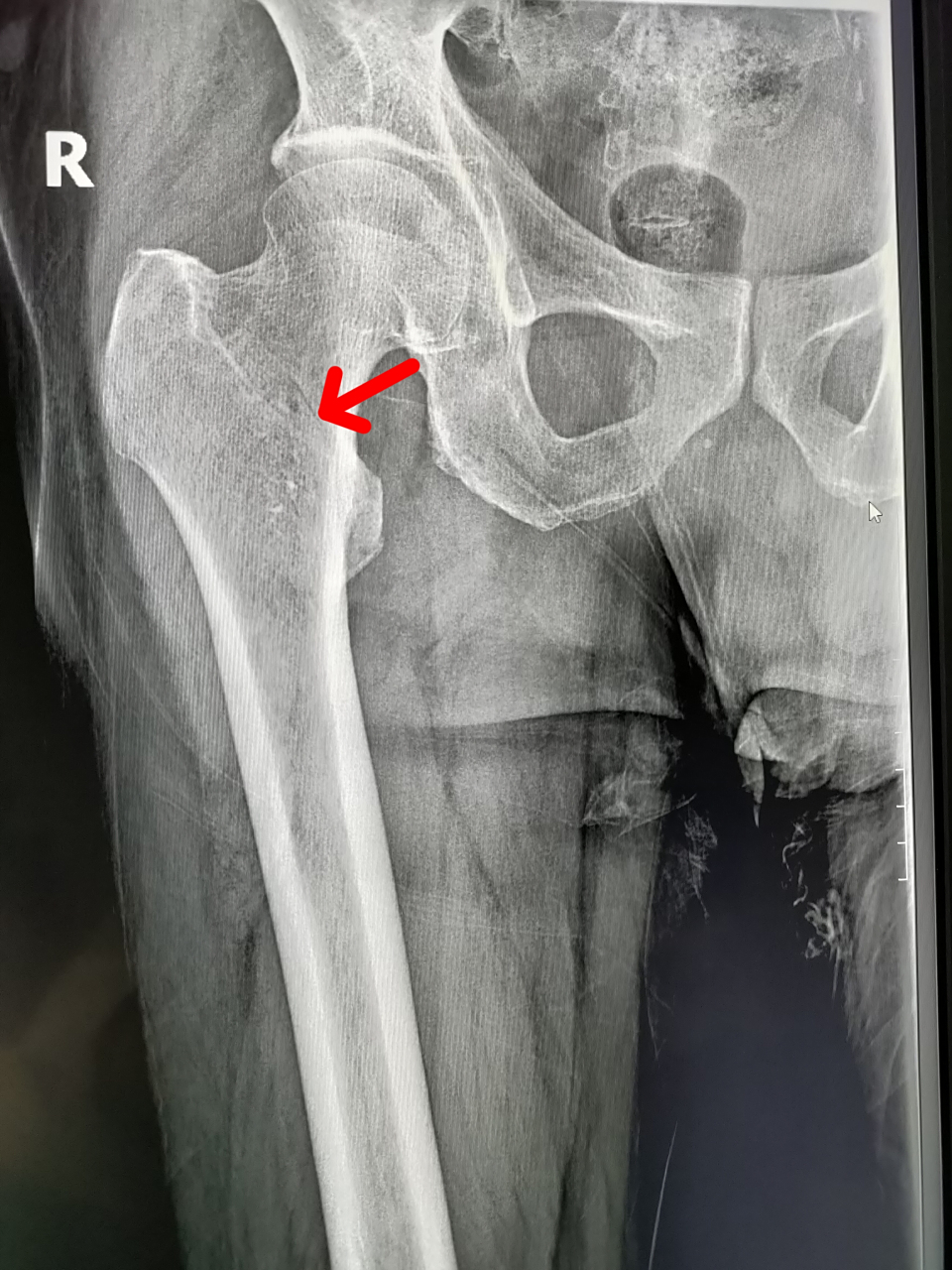 大清早的一外伤病人,男,67岁,因滑倒就诊,右股骨粗隆间骨折,就是我们