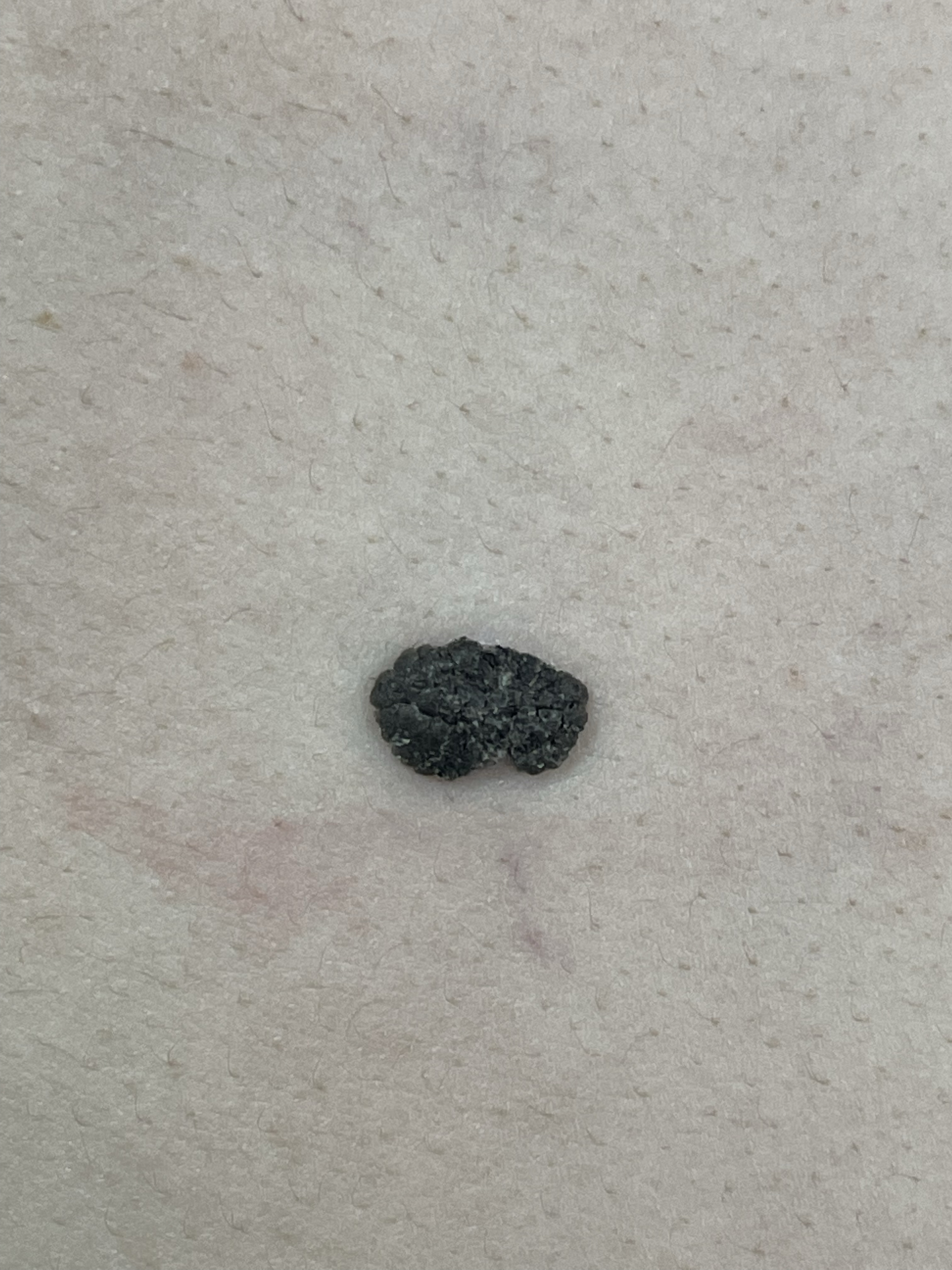 容易误诊为色素痣的脂溢性角化病