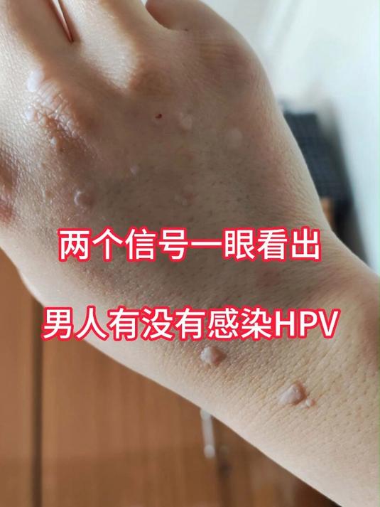 男性hpv真实图片 取样图片