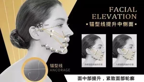 线雕悦升线提升效果如何呢?