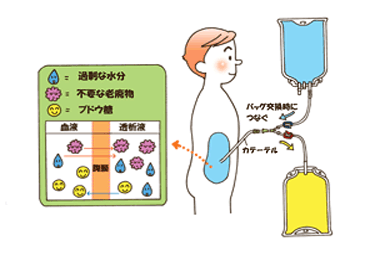 尿毒症常见治疗方法的优缺点