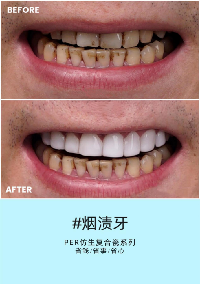 缘忆牙齿美学:仿生复合瓷美牙价格多少一颗?应该注意些什么!