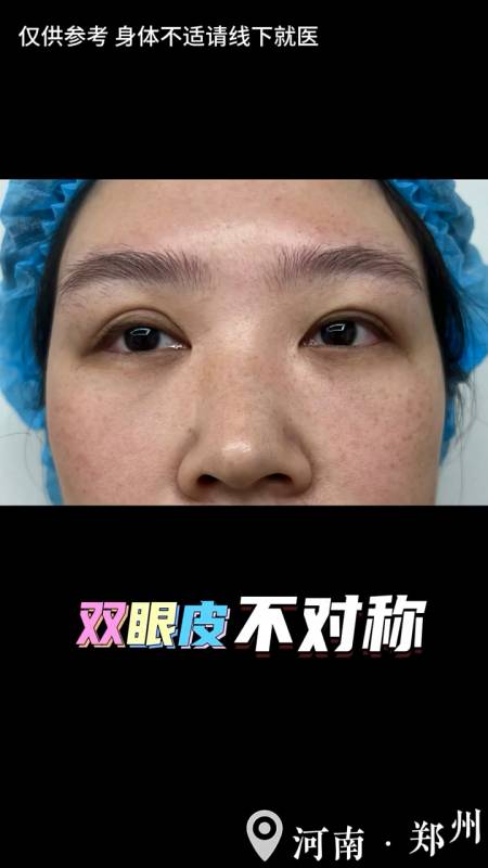 双眼皮不对称线条不流畅双眼无神?那就来试试双眼皮修复吧-度小视