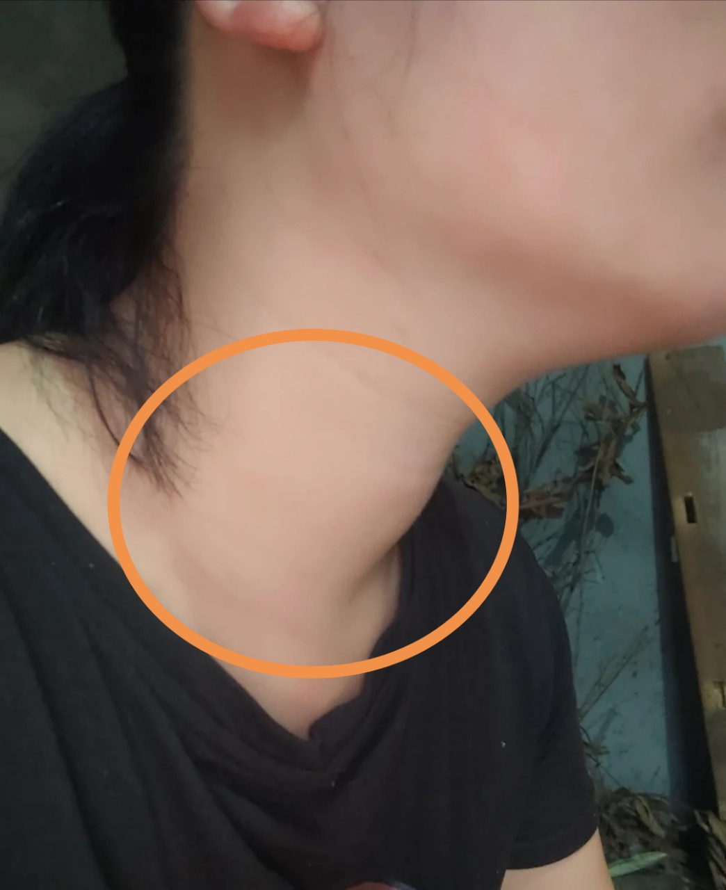 和"粗脖子"告别,战胜甲亢的对比图