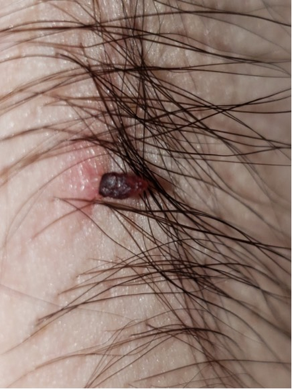 腋窝里长的软软的肉疙瘩,叫皮赘,一旦根部被腋毛缠住或者某种原因扭转