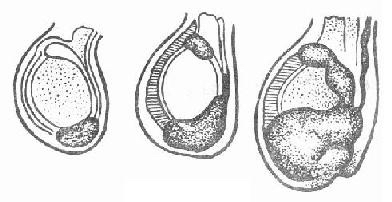 宝宝睾丸积液蛋蛋图片图片
