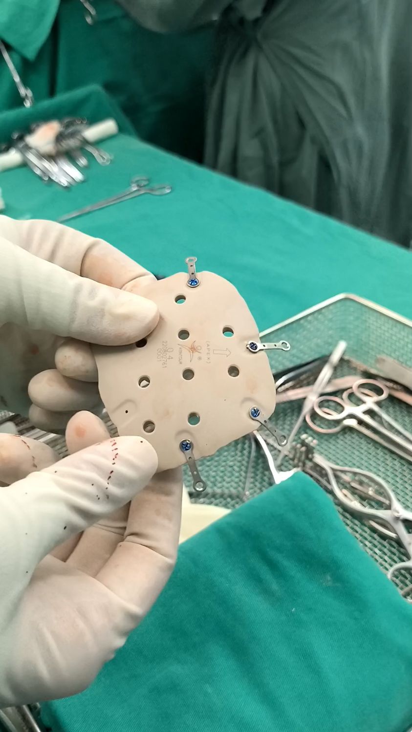 颅骨修补peek材料