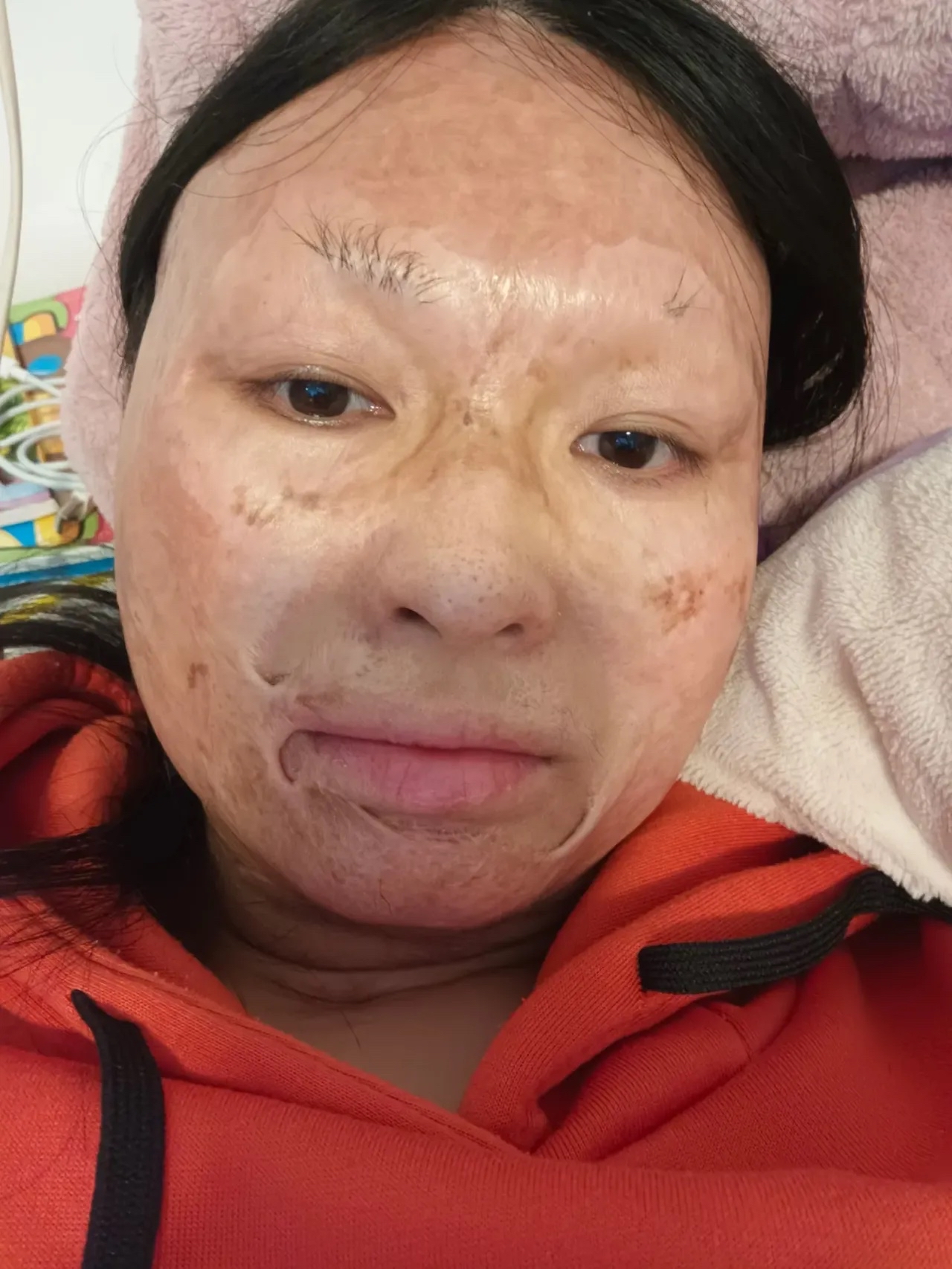 有人问我,烧伤这二十多年是怎么走过来的