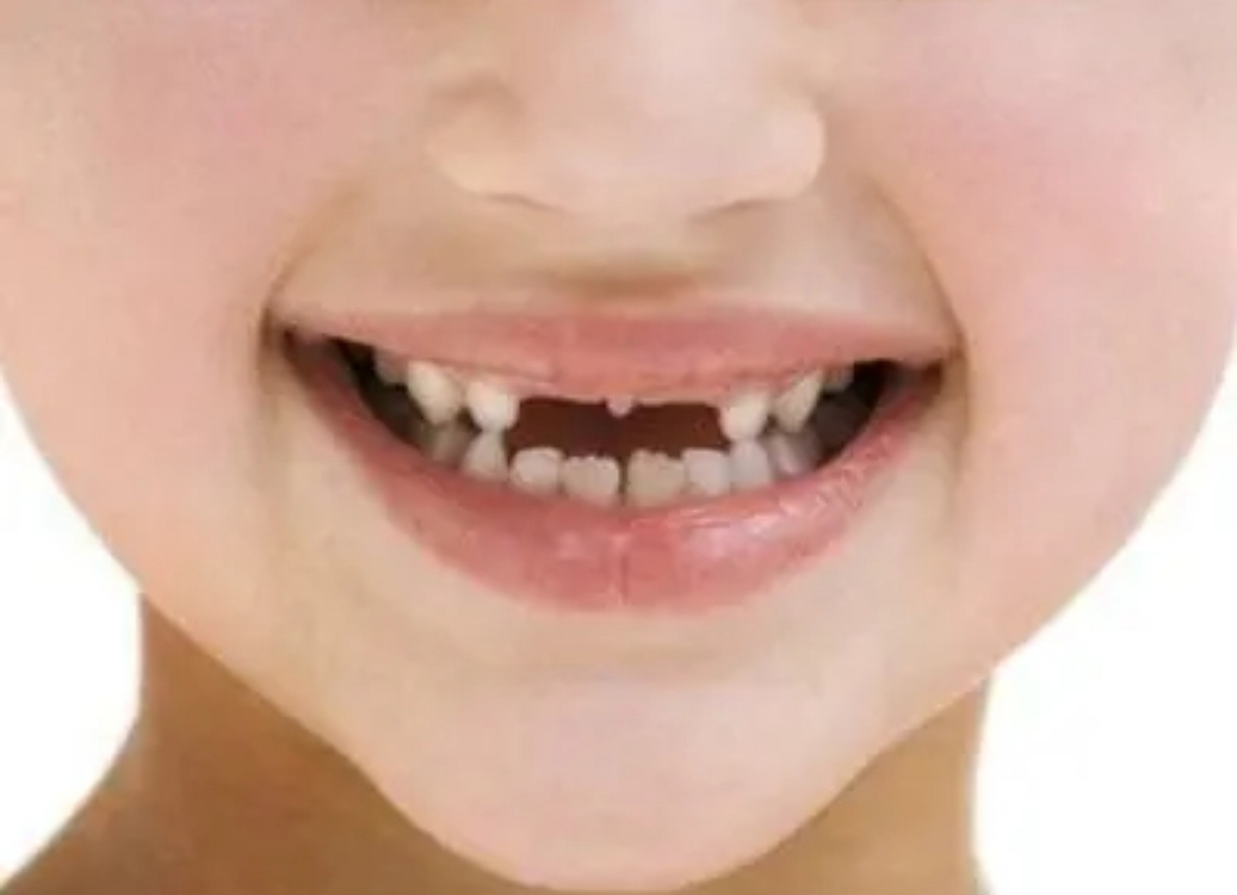 播种乳牙  小宝哥左侧长出来一颗新牙,位置不对,横向生长了,本应该换