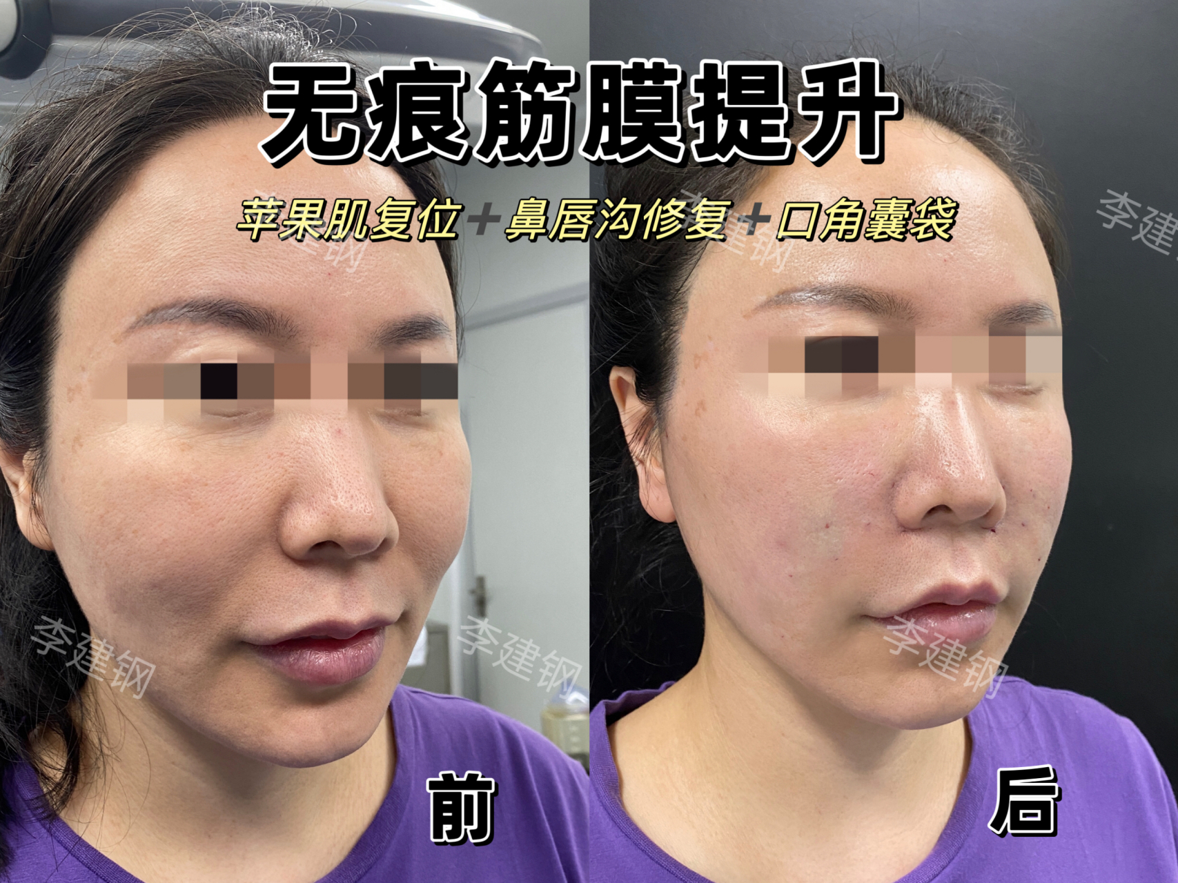 筋膜提升即刻效果,一下年轻了十几岁!