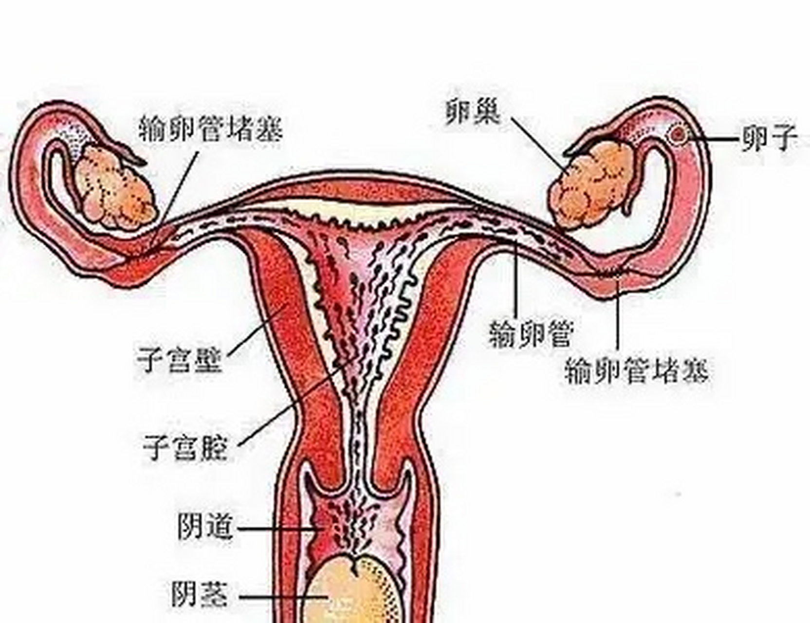 女人的输卵管堵塞图片图片