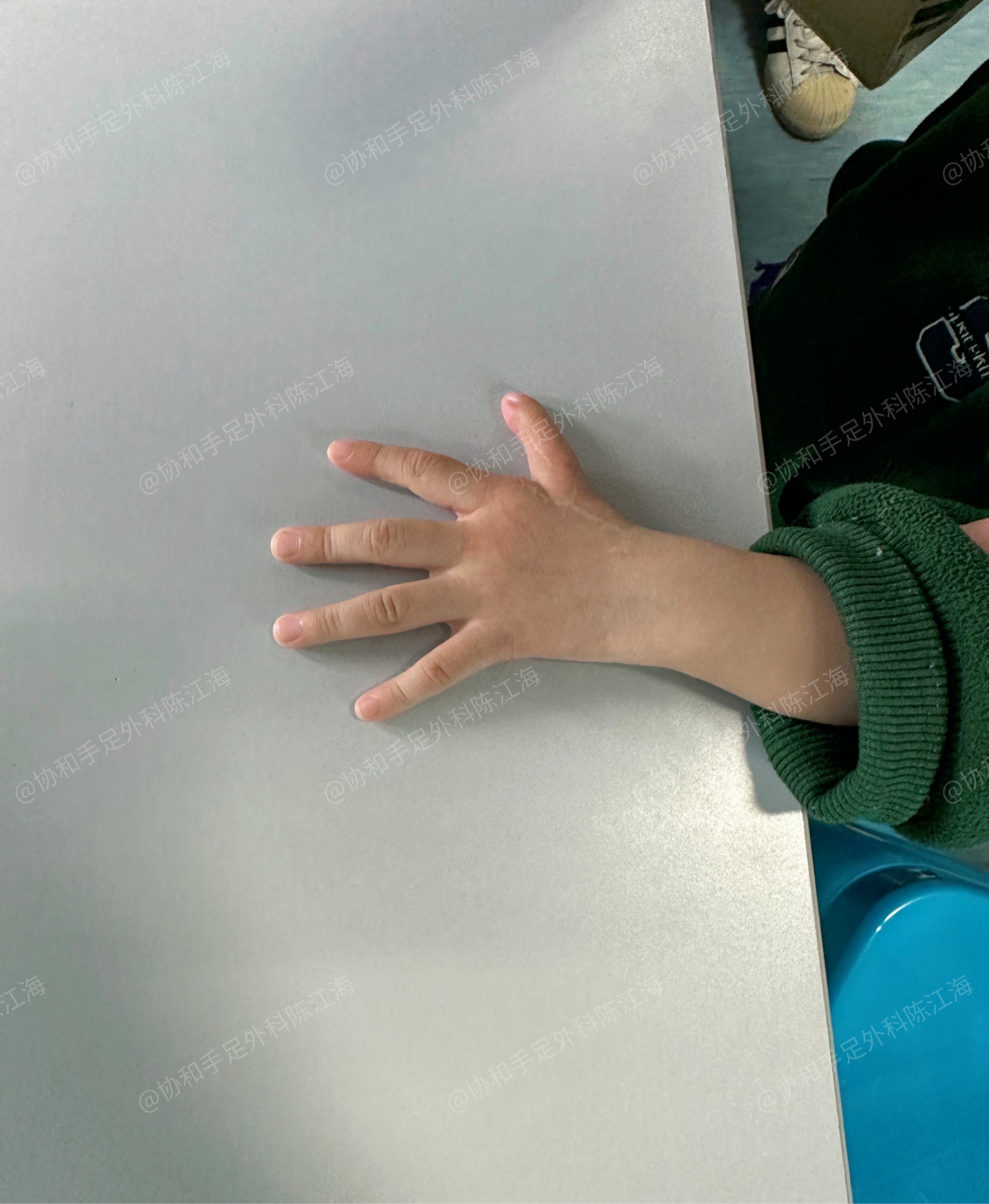 "孩子拇指细小,不能动,缺了一根掌骨,可以把我的骨头给他吗?