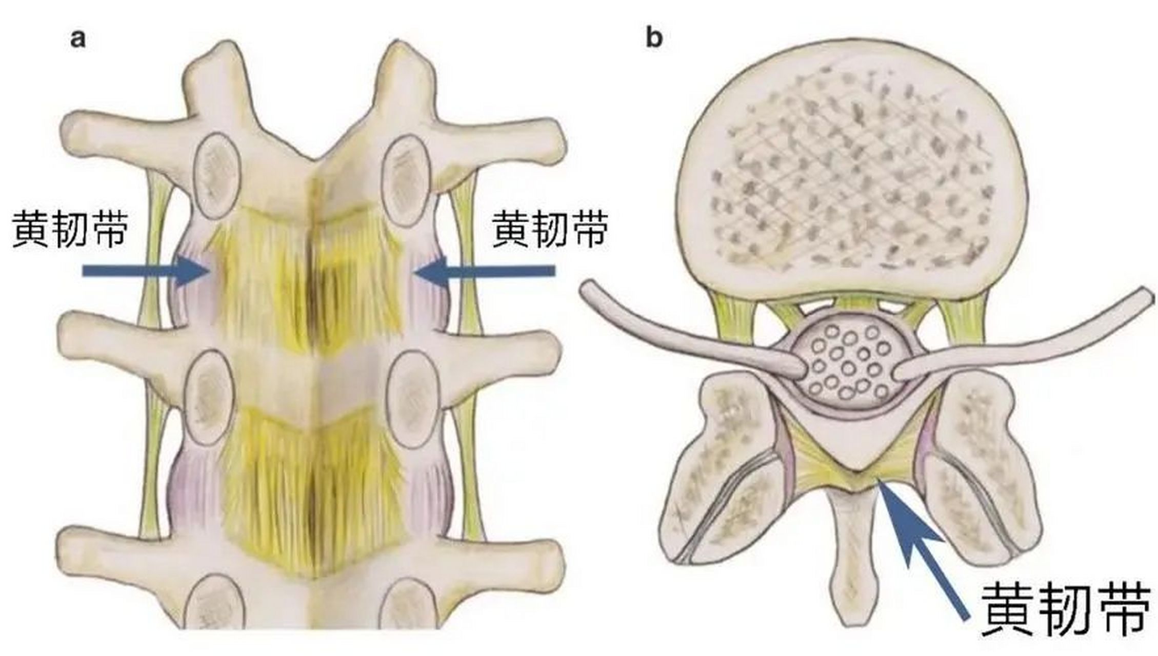 黄韧带是黄色的,我们医学上叫黄韧带,在我们腰椎管椎板之间,包括关节