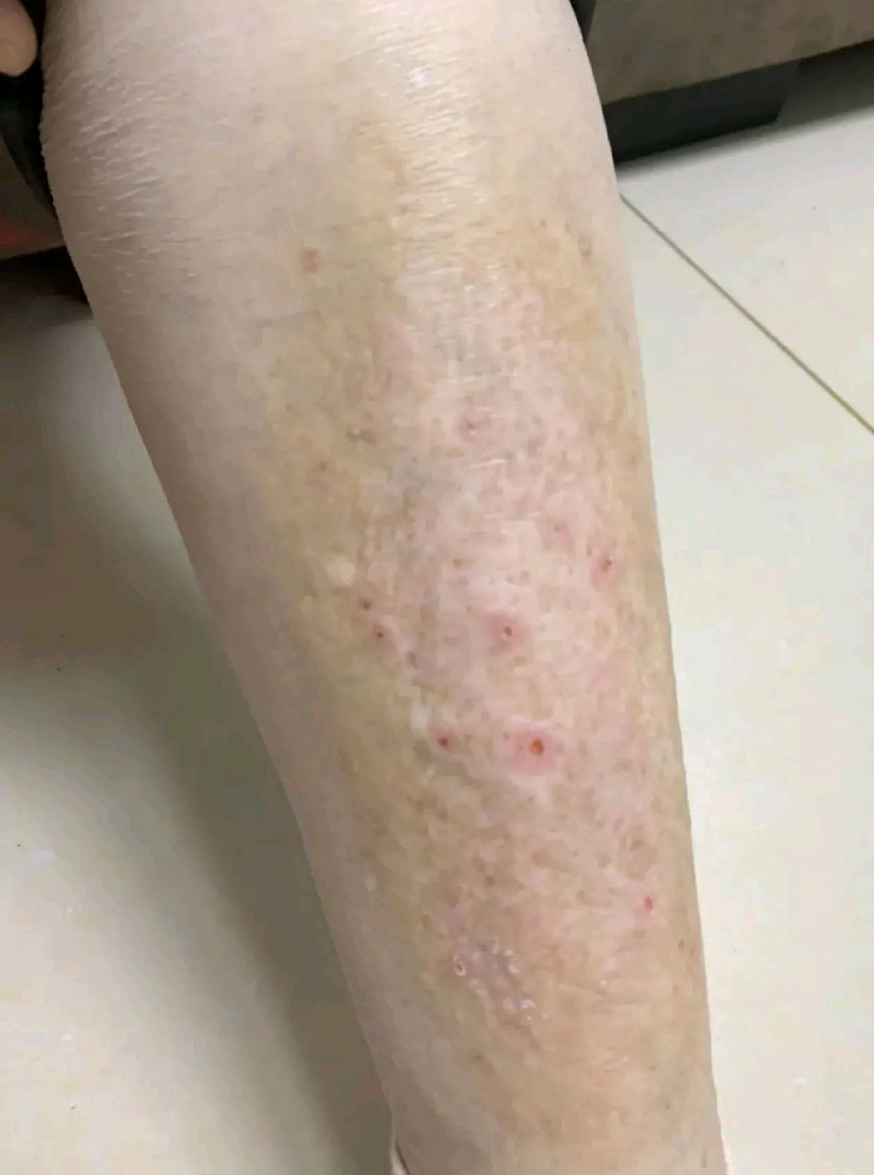 双小腿前皮肤瘙痒,长褐色斑多年是什么原因?