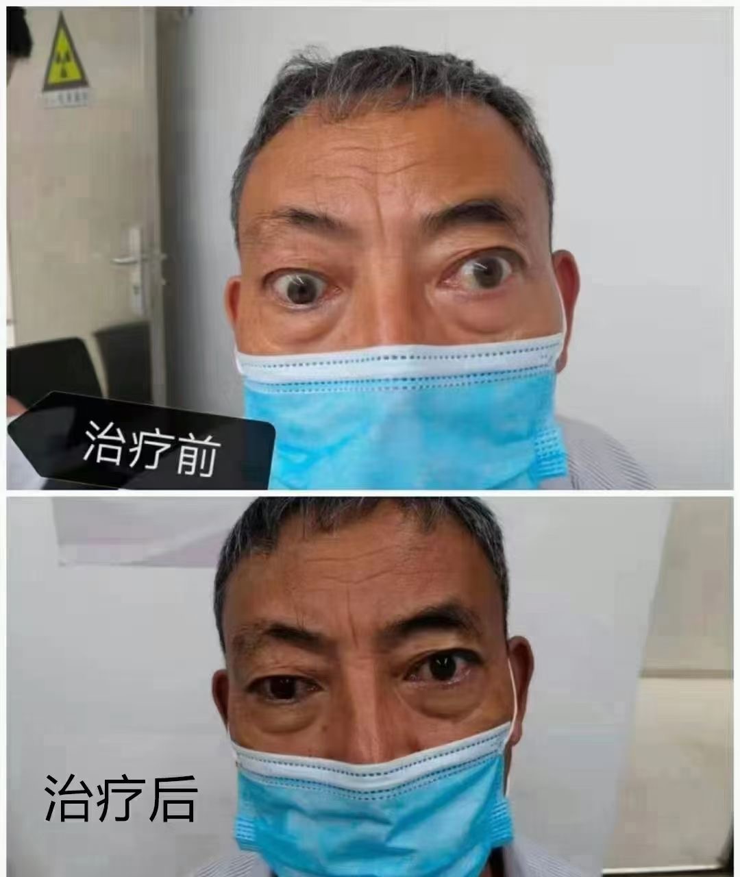 甲亢突眼治不好,中醫有辦法!