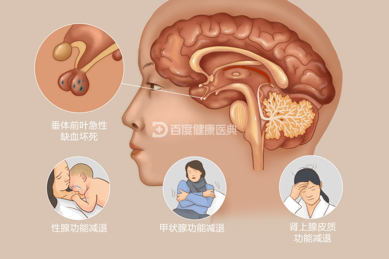 席汉综合征图片