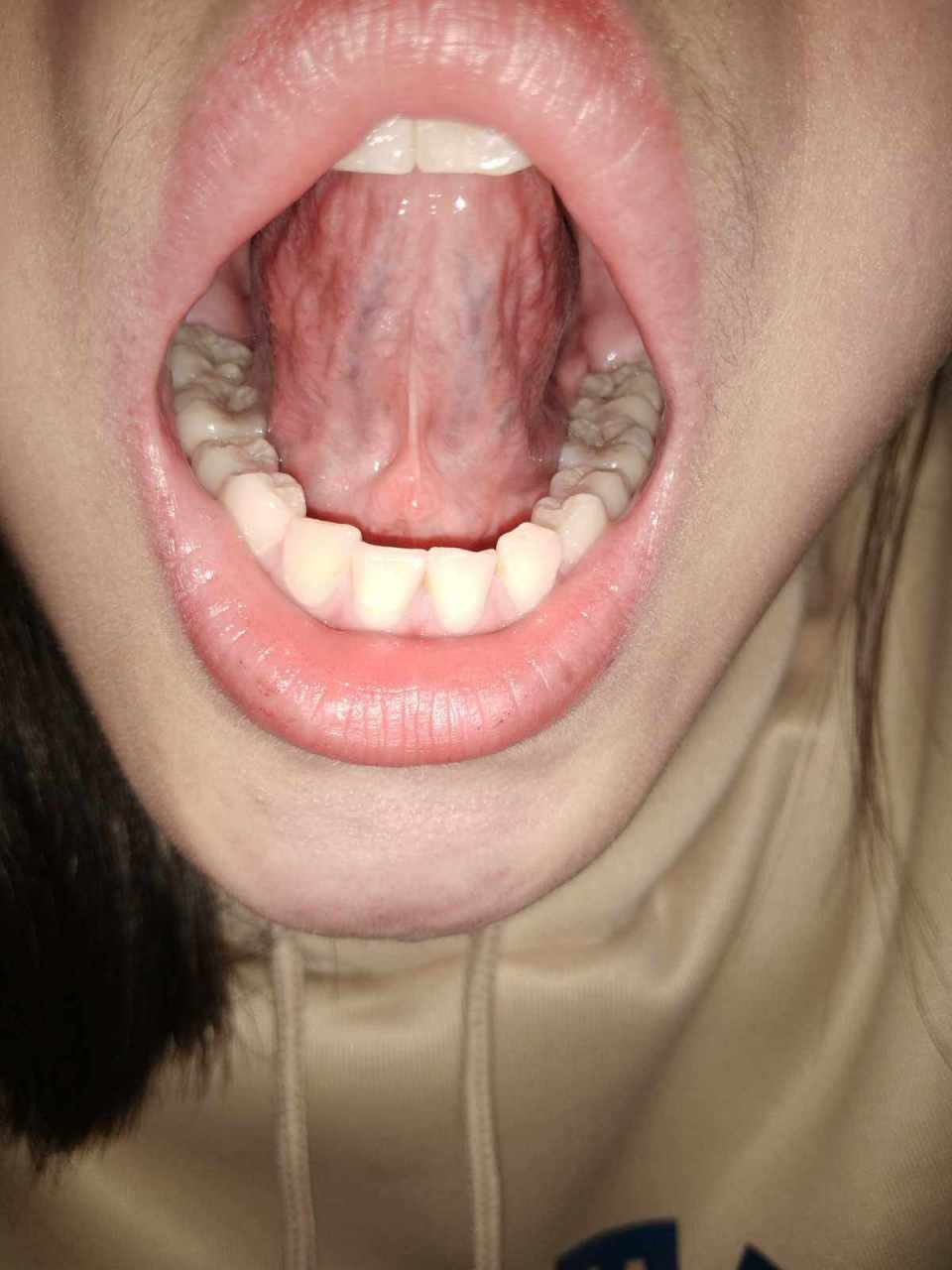 第1种正常的舌头:  舌下青筋一般淡青色的.