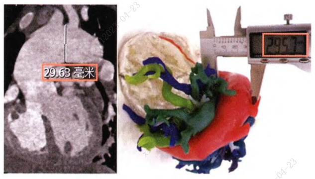 賽納數字醫療3d打印機打印複雜先天病心臟模型的精確性評估