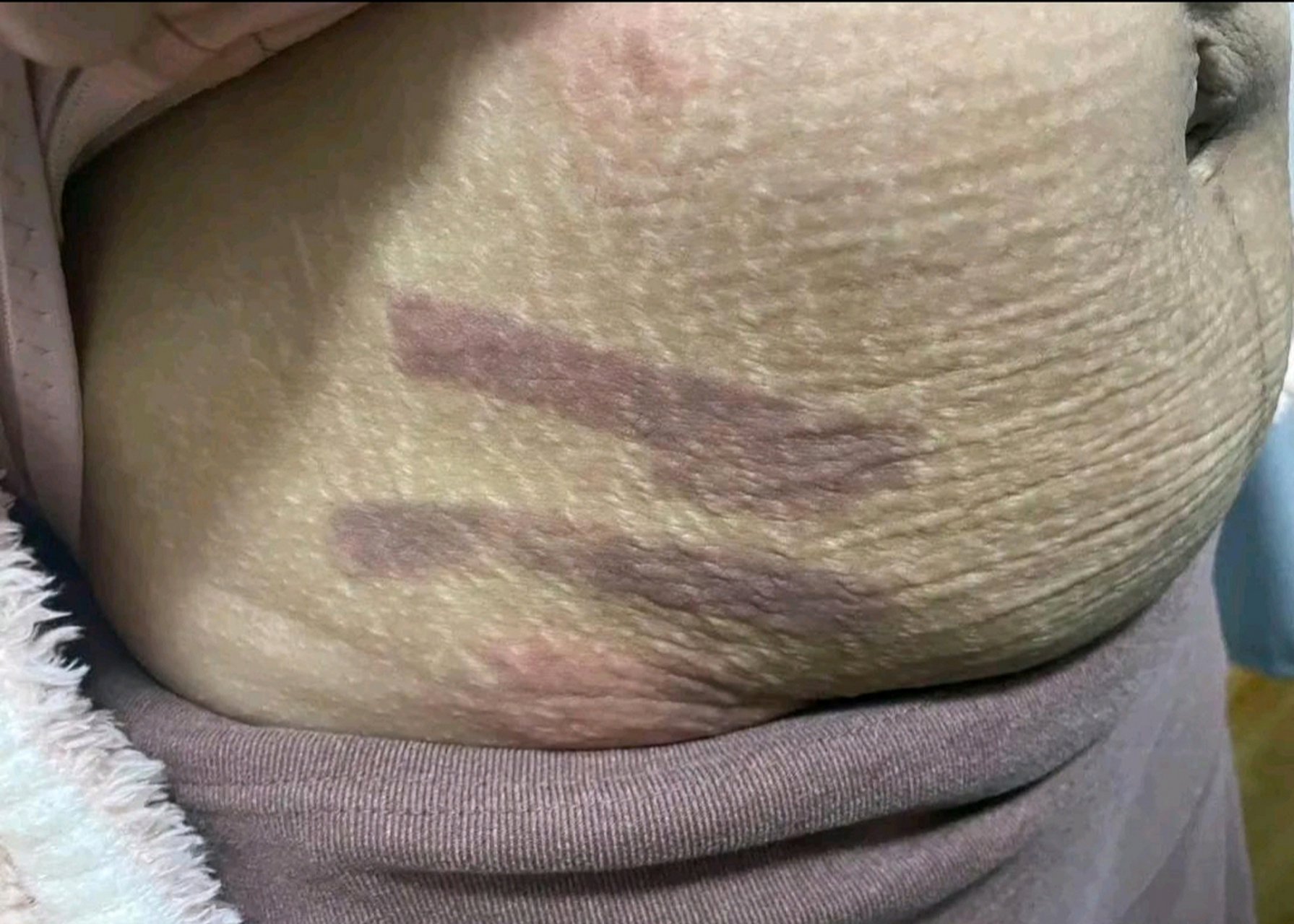 生完孩子长了一肚子的妊娠纹!现在出门都不愿意去,我是抑郁了吗?