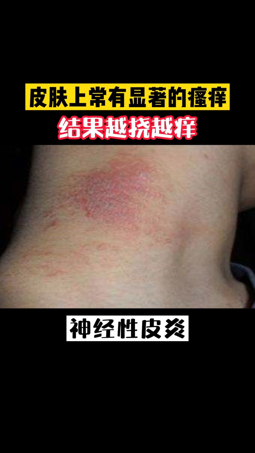 神经性皮炎是一种常见的以剧烈瘙痒为主的皮肤病跟什么有关呢该怎么办