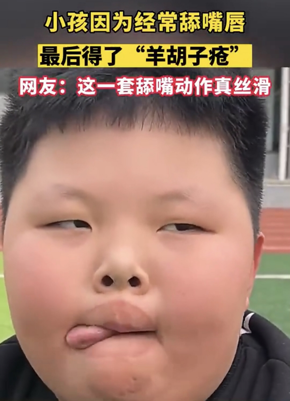 小孩因为经常舔嘴唇,最后得了"羊胡子疮",网友:这一套舔嘴动作真丝滑.