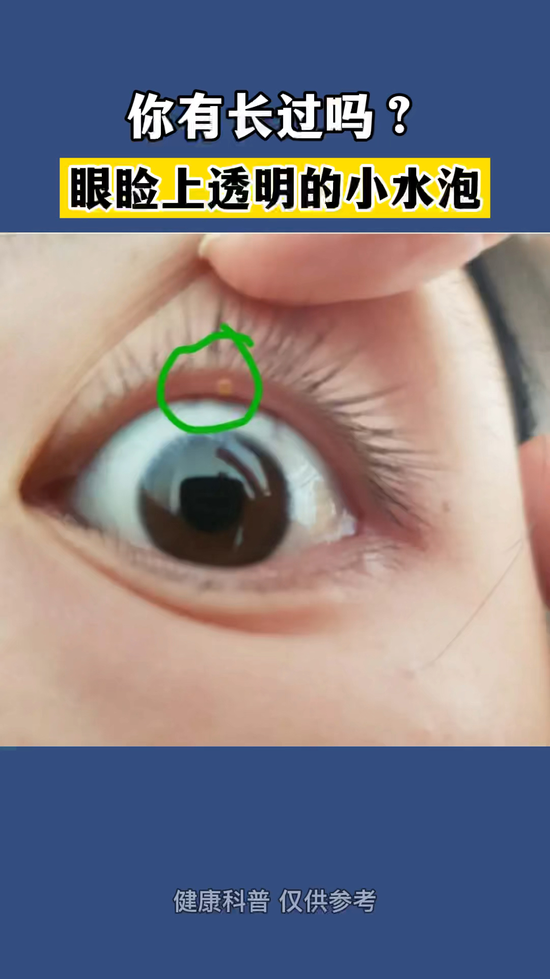 眼睑上的小水泡是怎么回事呢-度小视