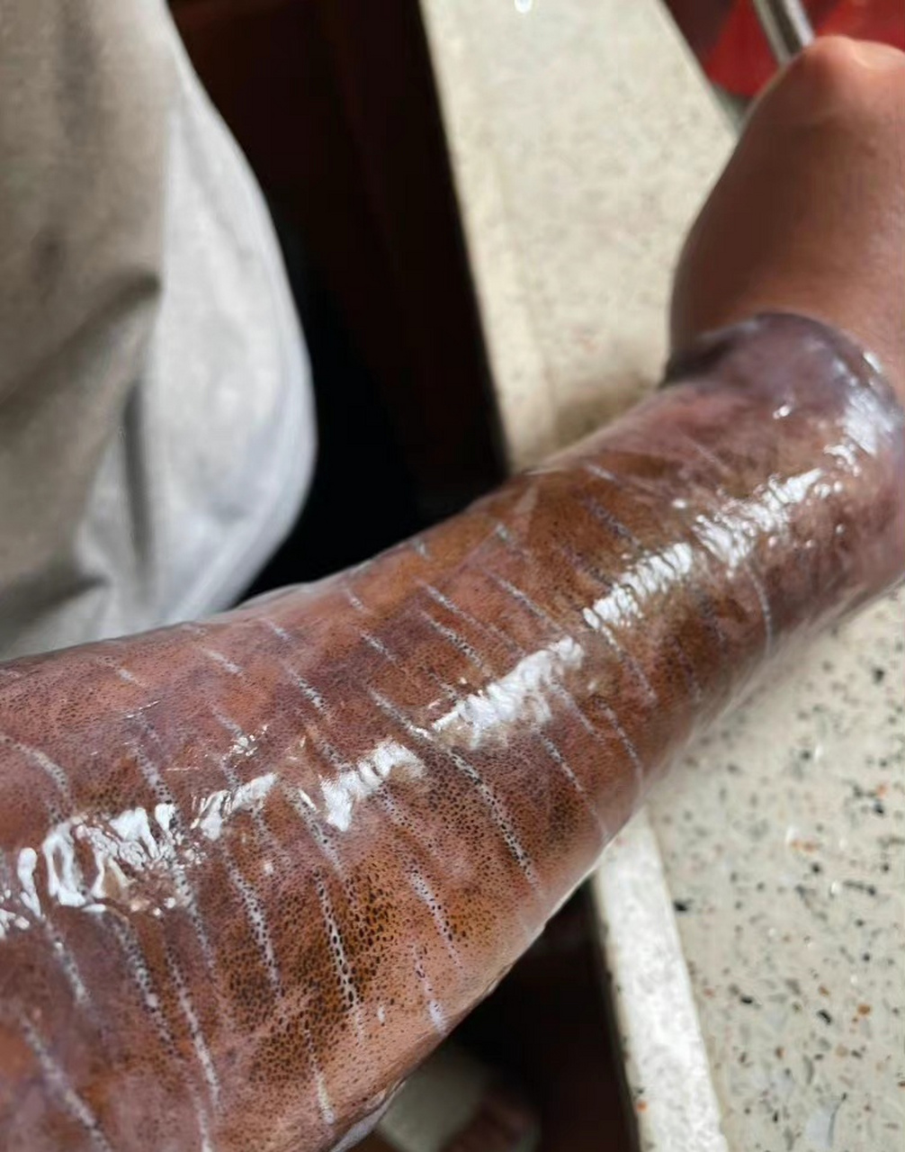 这手臂能看出来啥情况吗? ​​​