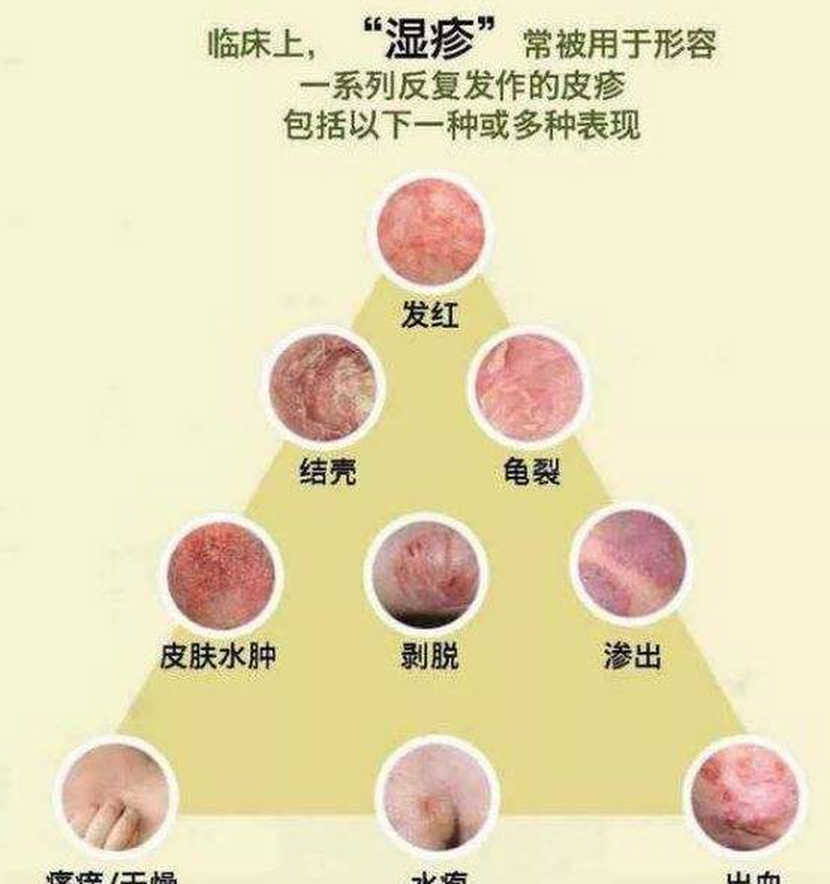 今天给大家说点儿关于湿疹反反复复发作的原因.