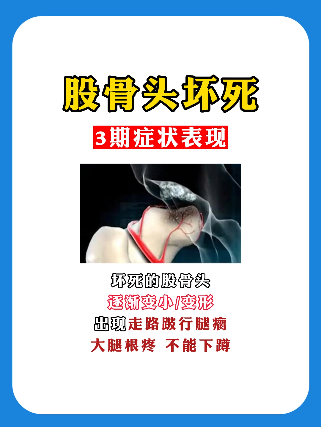 股骨头坏死4个时期症状不同,对应看看你属于哪种?