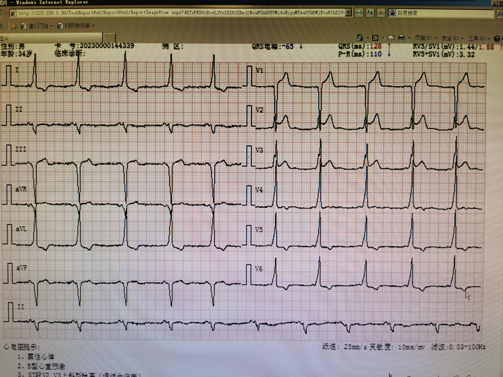 b型预激综合征消融术后复查,患者心电图恢复正常.