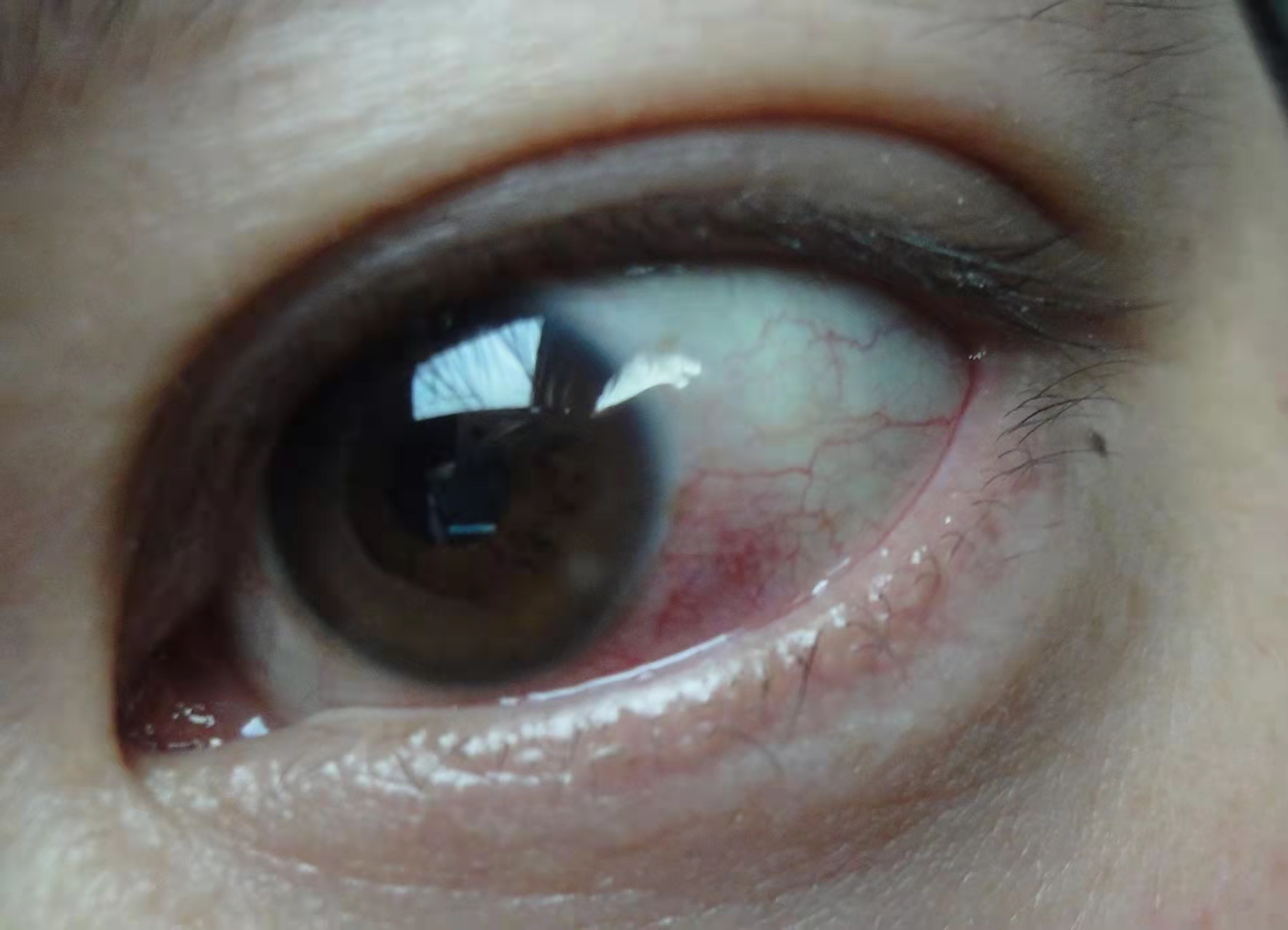 肝癌眼睛红血丝的图片图片
