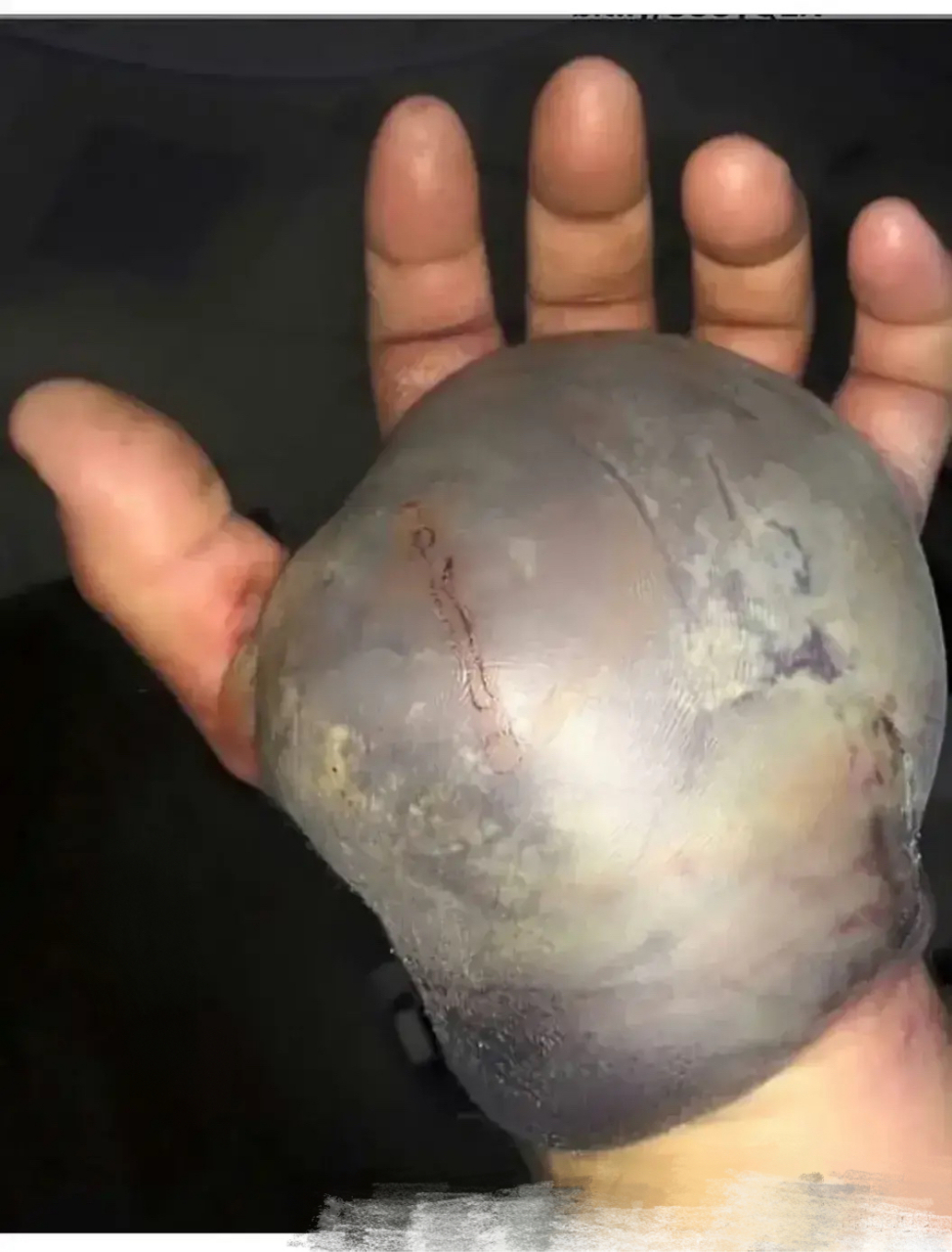 被蛇咬了一口,肿成这样子还有得救吗? 在线等,急死个人了!