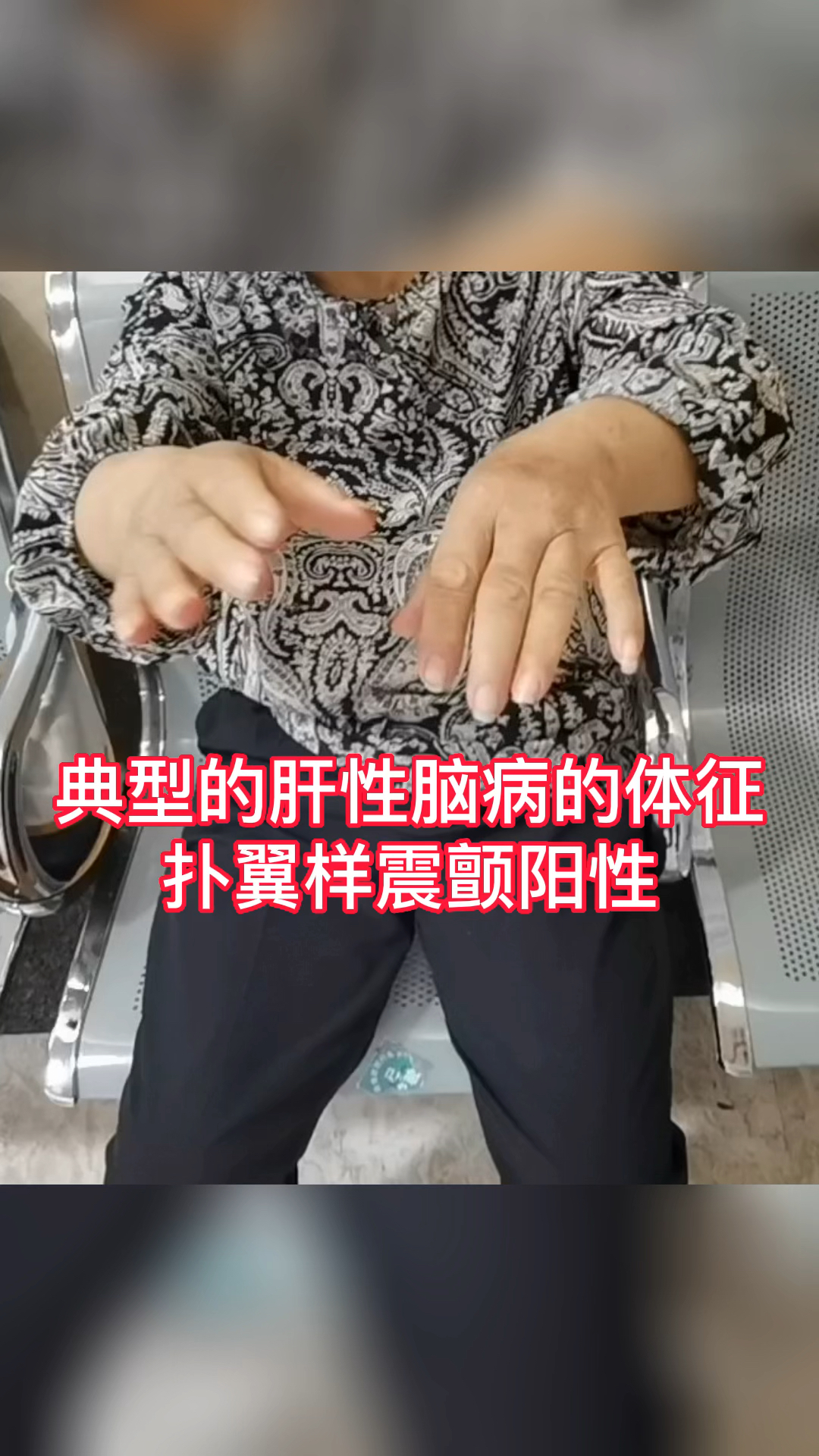 肝性脑病扑翼样震颤图片