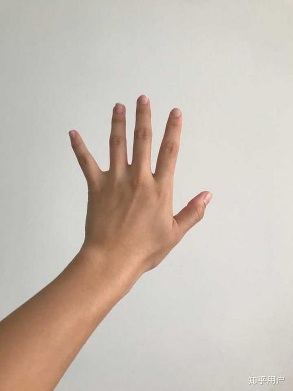 健康# 手部拇指外翻康复,你需要知道的8大关键知识点!