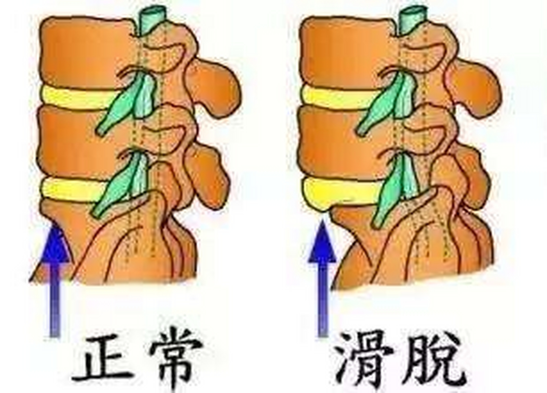 腰椎滑脱和腰椎间盘脱出是一样吗 经常有患者问我,医生我这个椎间盘