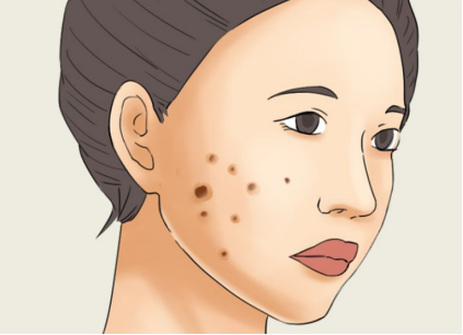 鲜红斑痣误区大盘点,看你中招了没!