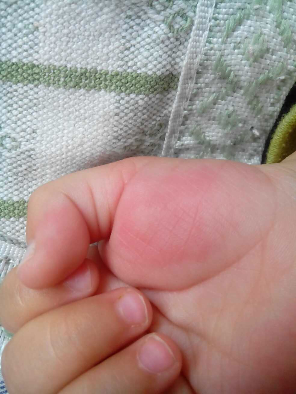 炎炎夏日,大家有没有被蚊子咬过手掌呀?