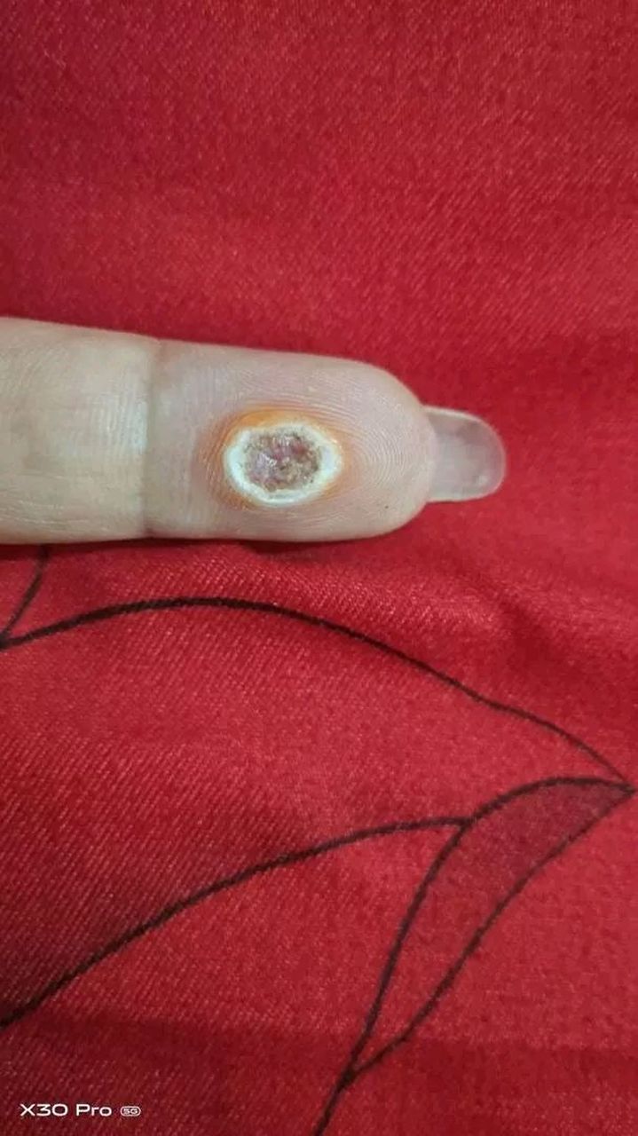 手上长了个鸡眼,买东西回来贴,结果把自己的手贴成这样了,哎,我为什么