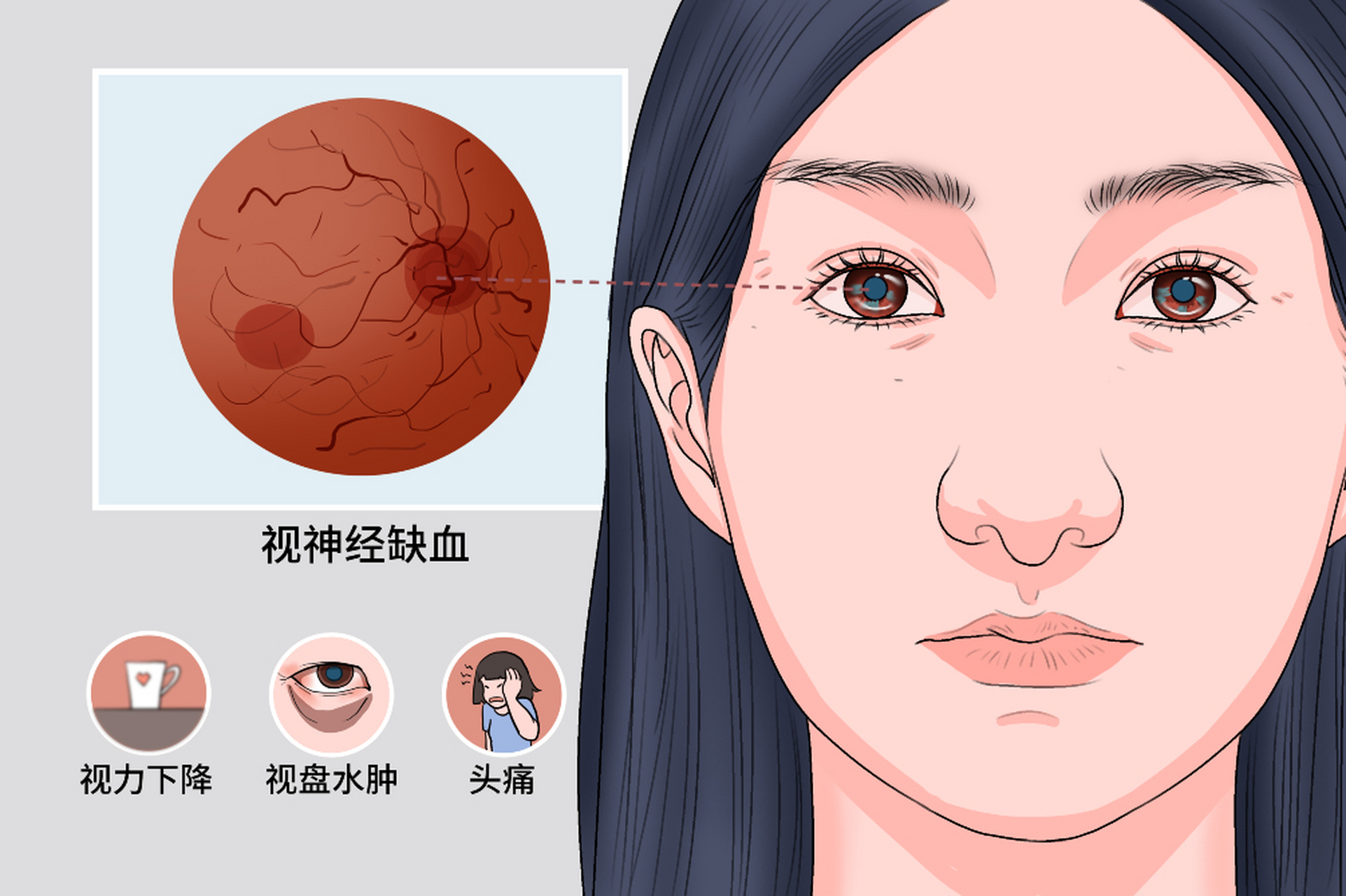 视神经缺血怎么治疗 缺血性视神经病变是由于为视神经提供营养的血管